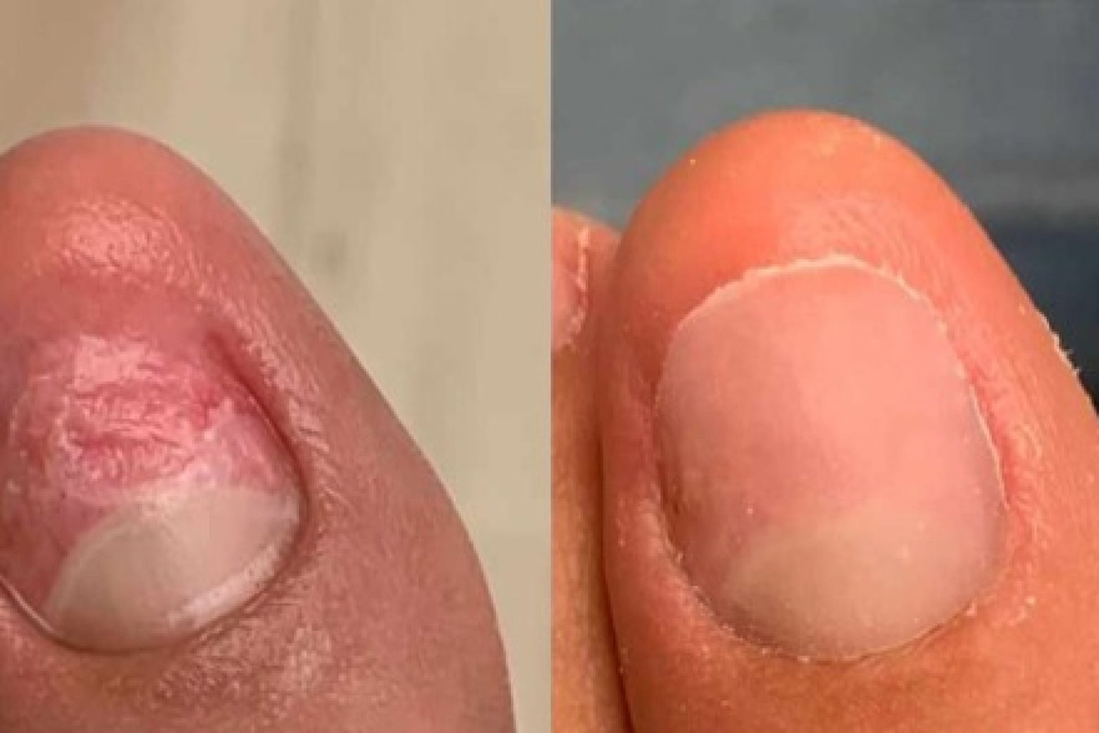 RECONSTRUCCINUNGUEAL1739364951