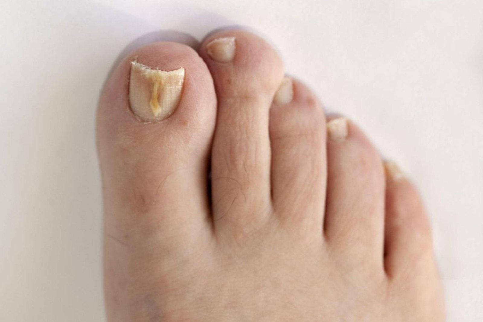 TRATAMIENTODEMICOSIS1739364951