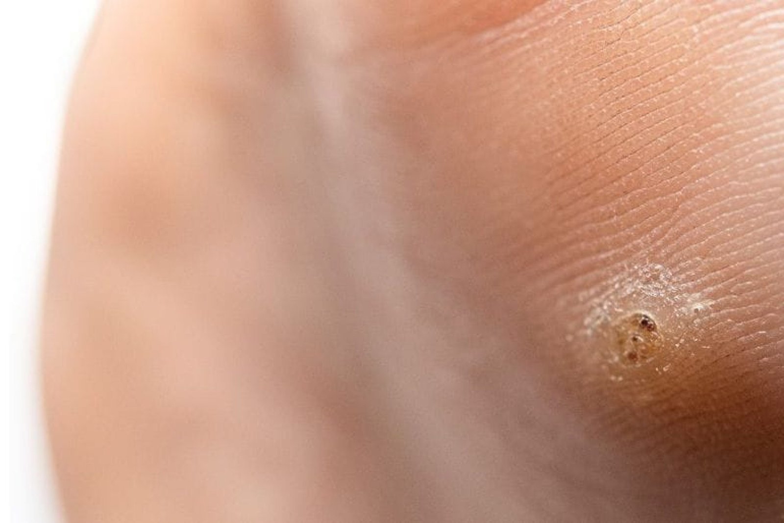 VERRUGAPLANTAR1739364951